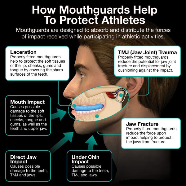 How Mouthguards Help To Protect Athletes?
